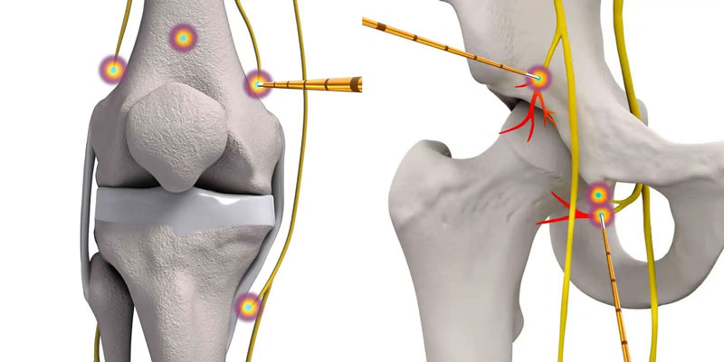 Radiofrequency ablation is offered at The Bay Orthopaedic & Fracture Clinic in Hervey Bay