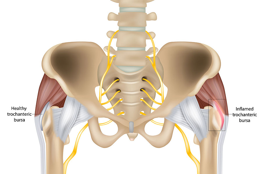 Medical illustration comparing healthy trochanteric bursa vs inflammed trochanteric bursa