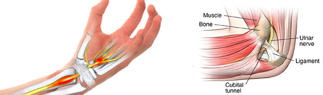 Medical illustrations of carpal tunnel and cubital tunnel