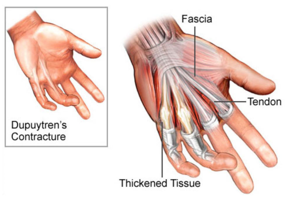 Medical illustrations of Dupuytren's contracture
