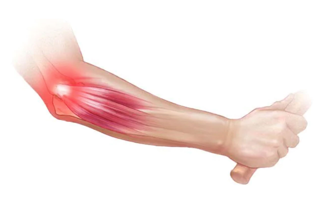 Medical illustration of tennis elbow