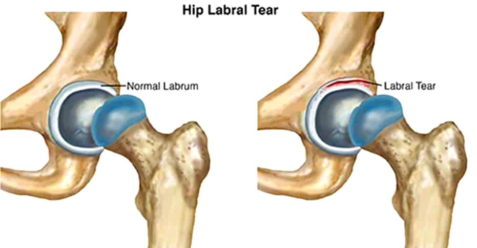Medical illustration of normal labrum vs labral tear in the hip joint
