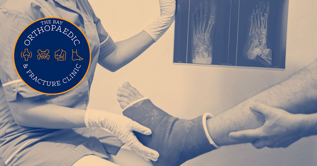Casts Braces and Splints The Bay Orthopaedic & Fracture Clinic
